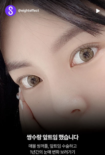 쌍수랑 앞트임 했습니다