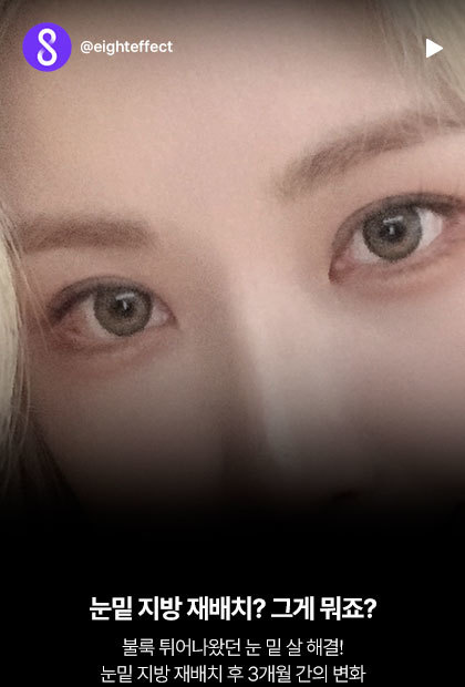 눈밑지방재배치? 그게 뭐죠?